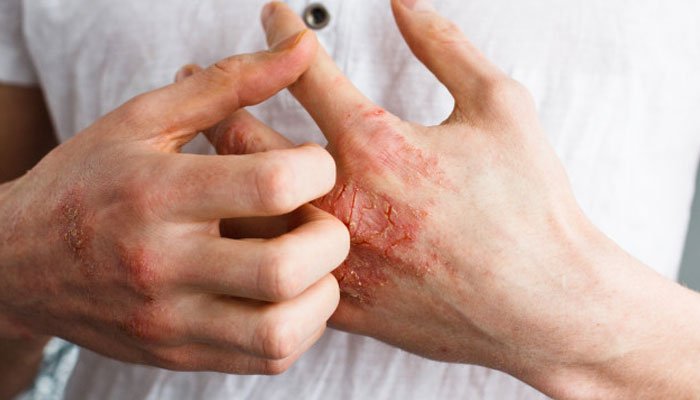 جلد کی ایسی 5 بیماریاں جو کورونا کی علامات ظاہر کرتی ہیں
